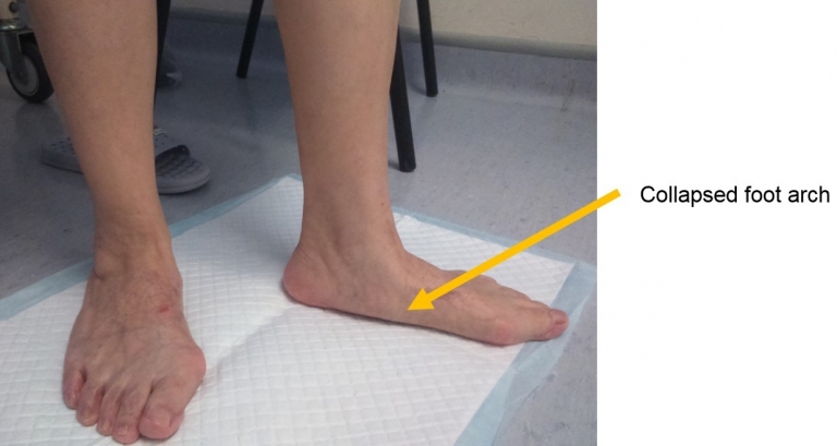 underpronation with flat feet